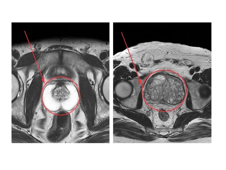 Comparația dintre o prostată sănătoasă (stânga) și una inflamată (dreapta) pe imaginile RMN